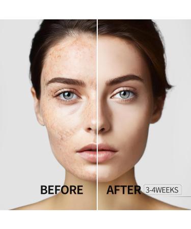 HANYWIL Dark Spot Remover for Face and Body Dark Spot Corrector Serum Age Spot Sun Spot Freckles Brown Spot Remover Melasma Treatment for Face Skin Care Serum with Roller - Buy Online on GoSupps.com