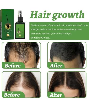 Teegxddy 2 pieces hair growth for men and women accelerates care solution prevents hair loss stimulates beard growth soft universal skin structure 30 ml - Buy Online on GoSupps.com
