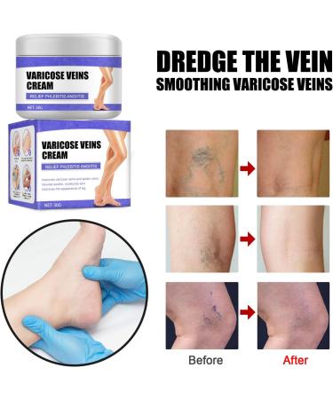 HADAVAKA Vein Care Fading Cream Varicose Vein Cream Leg Swelling Earthworm Leg Care Improve Blood Circulation Relieve Pain of Legs 2 - Buy Online on GoSupps.com
