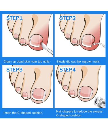 Ingrown Toenail Correction Kit - 103 Pack with 100 Corrector Strips, File, Lifter, and Clippers for Men and Women - Foot Care Solution - Buy Online on GoSupps.com