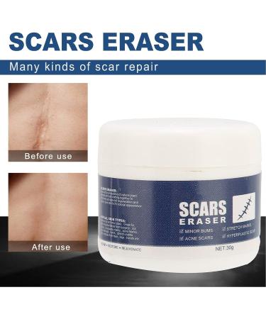 Scar Eraser Gel - Effective for Old & New Scars, Skin Repair & Removal Treatment - Buy Online on GoSupps.com