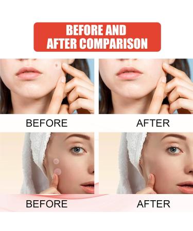 Zit Patches for Acne - 108Pcs Tea Tree Oil Clear Invisible Hydrocolloid Spot Dots - Day & Night Use - Buy Online on GoSupps.com