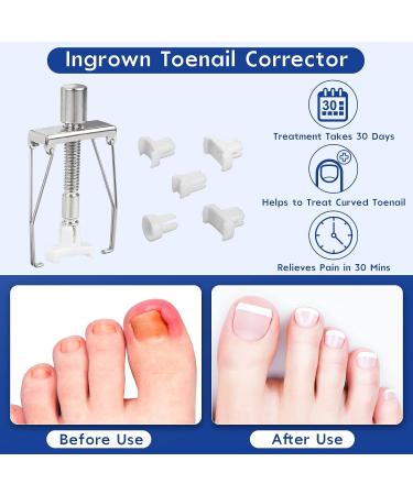 Professional Ingrown Toenail Treatment Kit - Includes Toenail Corrector, Tweezer, Strips, Braces, and Patches - Buy Online on GoSupps.com