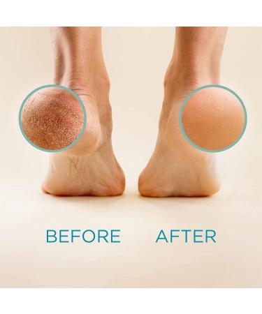 Lee Beauty Professional Callus Remover Gel (8 Oz) + Foot Rasp Spa Kit | Extra Strength Formula - Buy Online on GoSupps.com