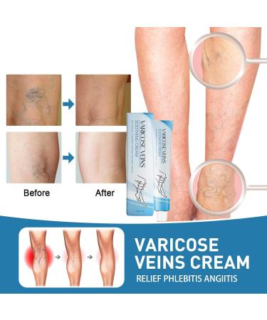 Raura Varicose Veins Cream Varicose Veins Cream Improves blood circulation - Buy Online on GoSupps.com
