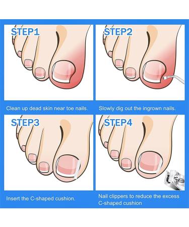 30 Pieces Ingrown Toenails Feet Ingrown Nail Set Ingrown Nail Lifter Ingrown Toenail Corrector Ingrown Toenail Toenails for Foot Thicknesses (Transparent) - Buy Online on GoSupps.com