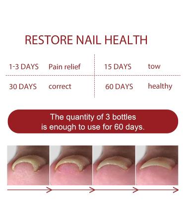 Top Nail Fungus Treatment: German ToenailPlus Kaluofan & More Effective Anti Paronychia Relief & Nail Care - Buy Online on GoSupps.com