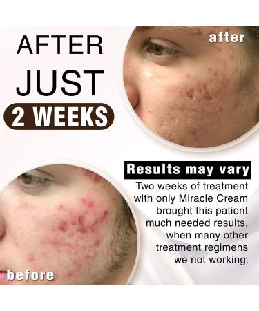 Anna Guanche MD Miracle Cream - Fast-acting Acne Treatment for Pimples & Redness - Buy Online on GoSupps.com