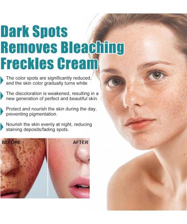 KOAHDE Fade Stain Beauty Cream Dark Spot Remover for Face and Body Freckle Remover Cream Skin Brightening Moisturizing Face Serum Dark Spot Correcting Glow Serum Corrector Cream for Face and Body - Buy Online on GoSupps.com
