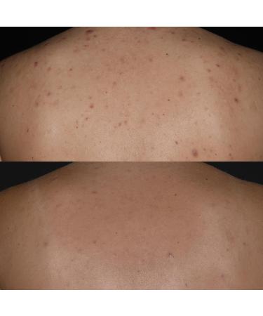 Ameliorate Transforming Clarity Body Spray 145ml | Lab6 Hyaluronic Acid Quora Noni | Dermatologically tested - Buy Online on GoSupps.com