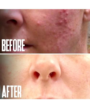 Glycolic Acid Peel 40% Professional Chemical Peel for Face for Acne Scars Collagen Boost Wrinkles Fine Lines - Alpha Hydroxy Acid Liquid Exfoliant for Face Peel Mask for Men & Women 1 Fl Oz (Pack of 1) - Buy Online on GoSupps.com