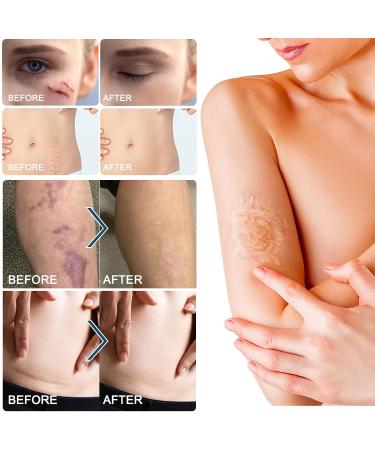 Medical Grade Silicone Scar Sheets - 1.6 x 120 Inch - For Old & New Scars - Safe & Painless Scar Removal - Face, Body, Surgery, C-Section, Keloid, Burn - 7 Months Supply - Buy Online on GoSupps.com