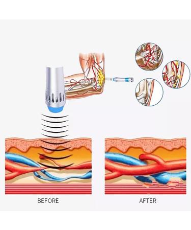 Shop Bative Shock Wave Therapy Device - 11 Massage Heads 12 Modes & Intelligent Heat for Effective Rehabilitation | International Shipping Available - Buy Online on GoSupps.com