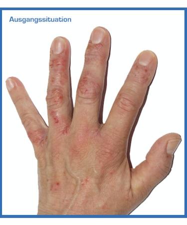 Prontomed SoleaDerm Cream 100ml | Neurodermatitis & Psoriasis Relief | Enriched with Rice Germ Oil & 5% Urea | International Shipping Available - Buy Online on GoSupps.com