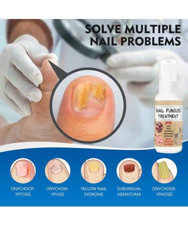 Effective Toenail Fungus Treatment - Restore Healthy Nail Appearance - Buy Online on GoSupps.com