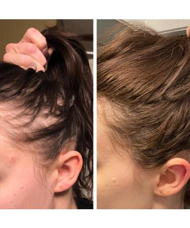 Ginger Oil & Biotin Hair Growth Serum - 100% Natural Treatment for Hair Loss Regrowth - Stronger, Thicker, Longer Hair - 1.0 Fl Oz (2 PCS) - Buy Online on GoSupps.com