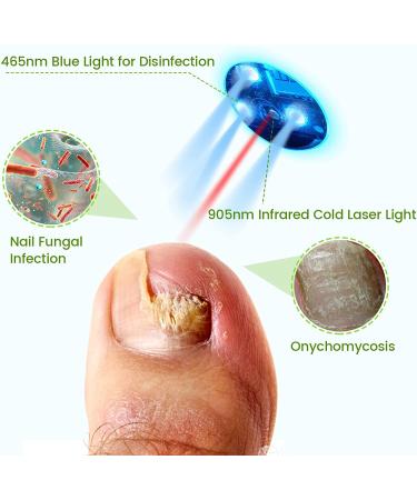Home Nail Fungus Laser Treatment Device - 905nm Infrared & 470nm Blue Light for Onychomycosis - Buy Online on GoSupps.com