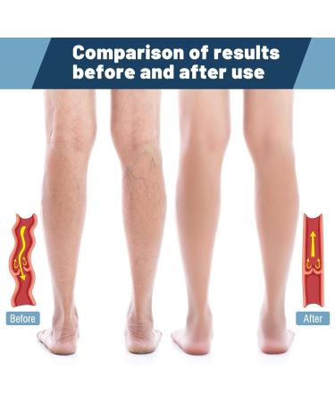 Buy Plus Size Compression Socks (S-7XL) 20-30 mmHg - Wide Calf Open Toe Support for Circulation Varicose Veins & Edema - USA Shipping Available - Buy Online on GoSupps.com