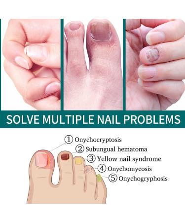 Anti-Fungal Nail Treatment Kit with Nail Clippers & Glass Nail File - Natural Ingrown Toenail Correction & Fungal Nail Repair - 2 in 1 Nail Care Solution - Buy Online on GoSupps.com