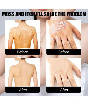 Yanolam Meellop Herbal Psoriasis Relief Spray - Soothes and Moisturizes, Stops Itching & Burning - 3 pc Eczema Relief Set - Buy Online on GoSupps.com