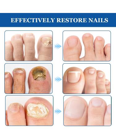 Cr me de Soin des Ongles Emollient Ongle Soin-Ongles Des Pieds Nourrissant et Renforce pour Ongles R paration D ongle Pour Les Ongle D color s paissis miett s Cass s 20g - Buy Online on GoSupps.com