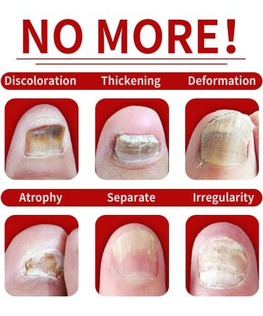 FLLUOUZH 3 Pieces 7 Days Ginger Nail Ginger Nail Treatment Nail Support Nail Care Ginger Nail Growth Serum Ginger Cuticle Care Oil for Nails - Buy Online on GoSupps.com