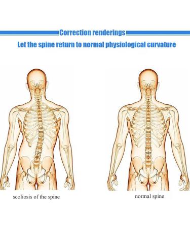 FoRes Thoracolumbar Fixation Bracket | Adjustable Scoliosis Orthosis | Breathable Mesh for Spinal Balance | Three-Point Mechanics Design - Buy Online on GoSupps.com