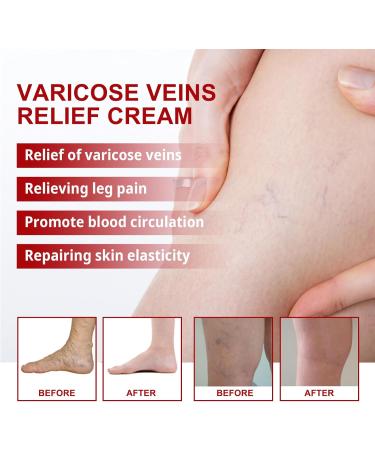  KOAHDE Cream for varicose veins cream for varicose veins cream for varicose veins cream for varicose veins cream for varicose veins 20g - Buy Online on GoSupps.com