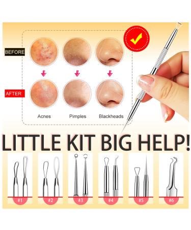 6-Piece Blackhead Remover Tool Kit with Case - Professional Acne Extraction Set for Pimple Popping, Whitehead Removal, Zit Removing - Nose & Face Blemish Treatment - Blue - Buy Online on GoSupps.com