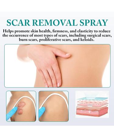 PARHAR Advanced Scar Repair Spray: For Facial Acne, Dark Spots, Surgical Scars, Stretch Marks - Gently Cares for Acne-Prone Skin, Relieves Itching - Suitable for All Scar Types - Buy Online on GoSupps.com