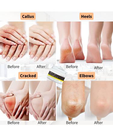 Tongyend Urea Foot Cream Urea 42% Foot Cream Cracked Heel Repair Cream For Dry Hard Skin Callus Remover Foot Moisturiser Nourishes Softens Dry Rough Cracked Dead Skin Foot Care - Buy Online on GoSupps.com