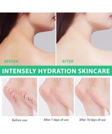 Urea 40% Foot Cream+2% Salicylic Acid Moist Cracked Heel Repair Cream Enriched With Tea Tree & Hyaluronic Acid & Aloe Vera Extracts Deeply Moisturising Gently Removes Dead Skin And Calluses 100g - Buy Online on GoSupps.com