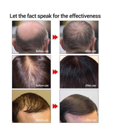 Herbal Hair-Growth Essence Spray - Anti Hair Loss Fast Grow Treatments Set - Buy Online on GoSupps.com