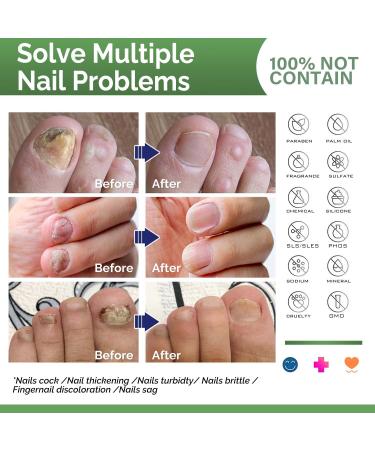 Healthy Nail Formula - Toenail Fungus Treatment & Repair Solution for Cracked, Discolored Nails - Buy Online on GoSupps.com