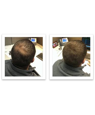 Caboki Hair Loss Concealer - All-Natural Hair Building Fiber for Fuller Hair. Cover Bald Spots and Thinning Areas. Dark Brown (30g) - Buy Online on GoSupps.com