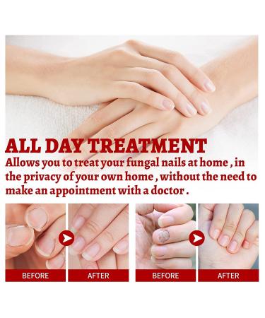 Onychomycosis Relief Oil - Rapid Toenail Repair & Ingrown Toenail Treatment (5 Sticks) - Improve Nail Health - Buy Online on GoSupps.com
