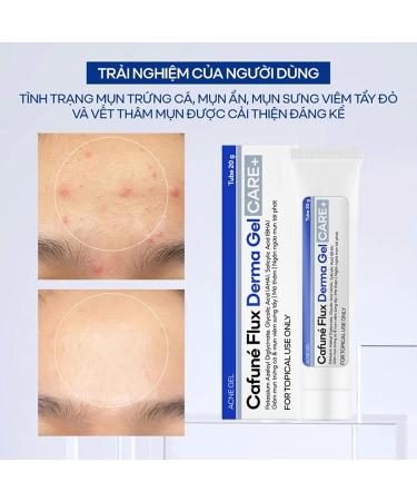 Facial Spot Treatment Gel | Fast-Absorbing Easy-to-Apply Non-Greasy Blemish Eliminator Anti-Pimple Facial Gel | For Women Girls Family Friends Colleagues Daily Use - Buy Online on GoSupps.com