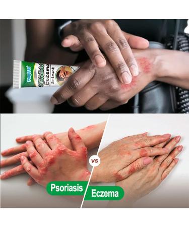 MagiSel Eczema Skin Care Cream 20g Anti Itch Cream Improves Dry Skin - Buy Online on GoSupps.com