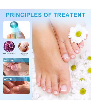 iKeener Nail Fungus Laser Treatment Device - Home Use Pain-Free Fungi Nail Remover for Fingernails & Toenails - Clean, Repair, and Cure Nail Fungus in Just 7 Minutes a Day - Don't Be Embarrassed Again! (Blue) - Buy Online on GoSupps.com