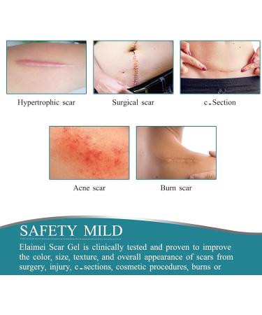 Medical Grade Silicone Gel Scar Removal Tape 1.6x60 - Long Strips for Acne, C-Section, Keloid Surgery - 6-8 Month Supply - 1.5m - Buy Online on GoSupps.com