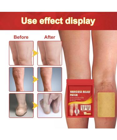 3 & 12 Piece Venous Plaster for Varicose Veins - Soothing Stickers to Relieve Leg Discomfort & Improve Appearance - Buy Online on GoSupps.com