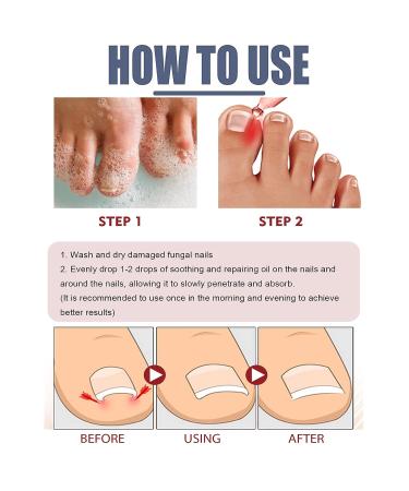 German Toenailplus & NailPro Anti Paronychia Relief Oil - Set of 2Pcs / 3Pcs - Buy Online on GoSupps.com