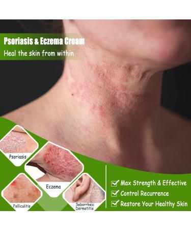 Natural Herbal Eczema and Psoriasis Cream for Sensitive Skin - Moisturizing Treatment for Dermatitis, Shingles, Acne, Rosacea - Anti-Itch Relief for Dry Skin (0.71oz, Pack of 6) - Buy Online on GoSupps.com