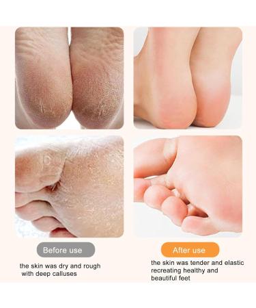 Electric Foot File | Rechargeable Skin-Friendly Foot Scrubber Dead Skin Remover - Automatic Powerful Heel Scraper for Cracked Heels Feet Hard Cracked Dry - Buy Online on GoSupps.com