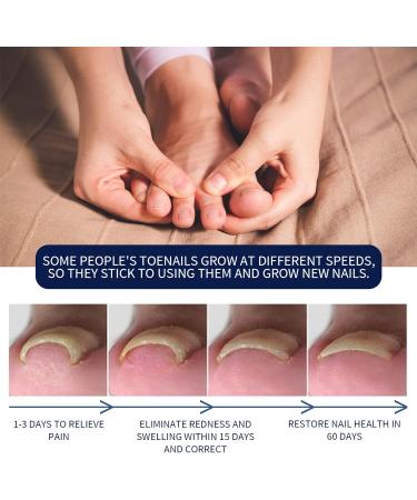 German Ingrown Toenail Drop: Paronychia Oil for Toenail Care - Nail Repair Solution (1pc) - Buy Online on GoSupps.com
