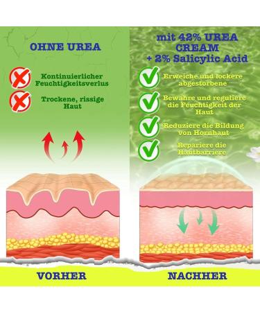 P-Beauty 42% Urea Cream | 2% Salicylic Acid | 150g Urea Foot Cream | With Aloe Vera Tea Tree Oil for Deep Hydration and Skin Softening - Buy Online on GoSupps.com