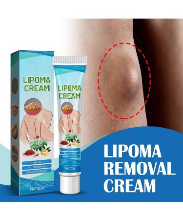 Lipoma Removal Cream 20g - Natural Treatment for Lipoma Care & Discomfort - Buy Online on GoSupps.com
