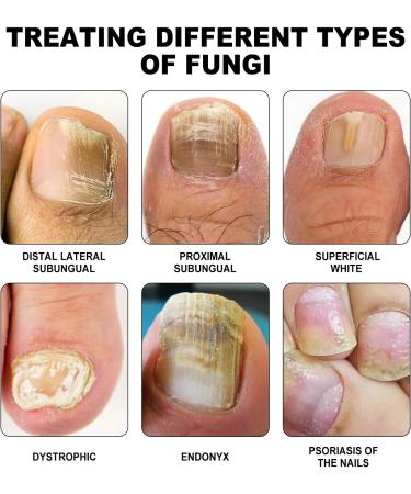SenhE Fungus Laser Therapy Device Antibacterial Laser Equipment Light Therapy Device Fungal Nail Revolutionary High-Efficiency Light Therapy Device for Toenail Diseases  - Buy Online on GoSupps.com