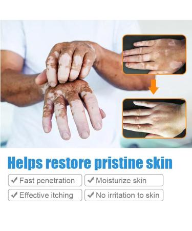 Vitiligo Therapy Cream: Soothing Ointment to Reduce White Spots & Improve Skin Pigmentation - Buy Online on GoSupps.com