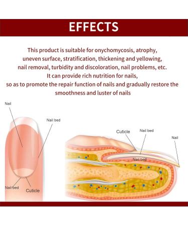 Fungal Nail Treatment - Nail Fungus Treatment For Toenail - Extra Strong Toe Nail Fungal Treatment - Anti fungus Nail Repair and Strengthen Fix & Renew Damaged Broken Nails - Buy Online on GoSupps.com